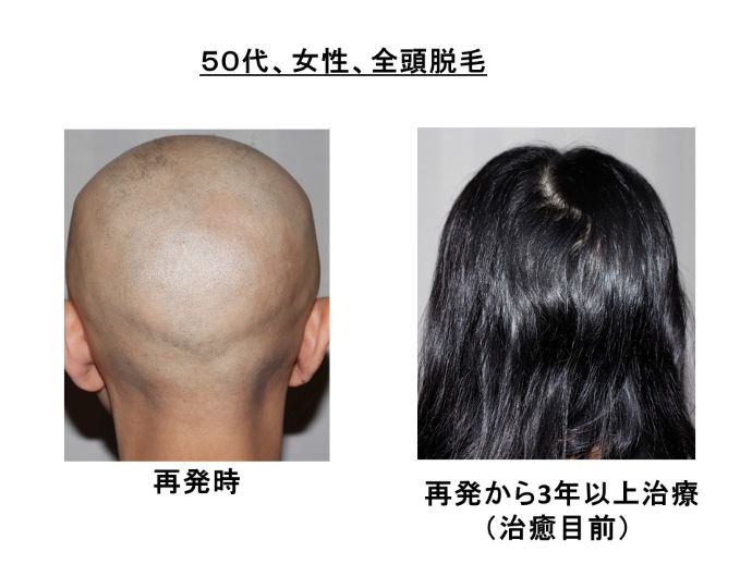 円形脱毛症　病院